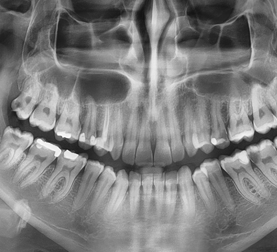Radiografie Dentară